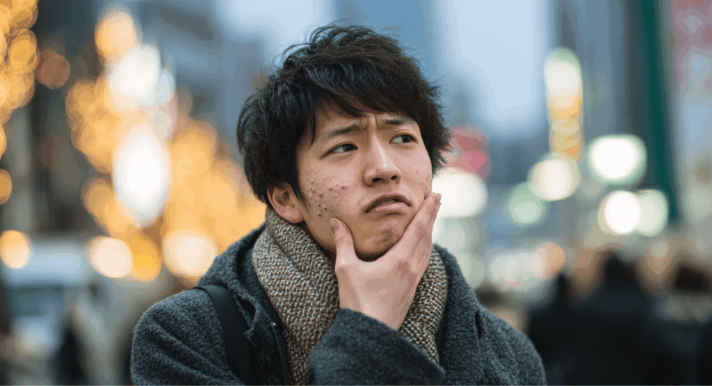 ニキビに悩んでいる男