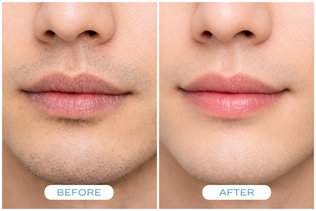 唇の乾燥Before＆After